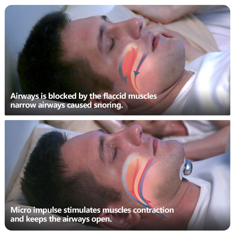 Smart Anti Snoring Device Electronic Muscle Stimulator Pro 386dc9c9-3c5c-4c62-bdea-f5b6fbed18dd
